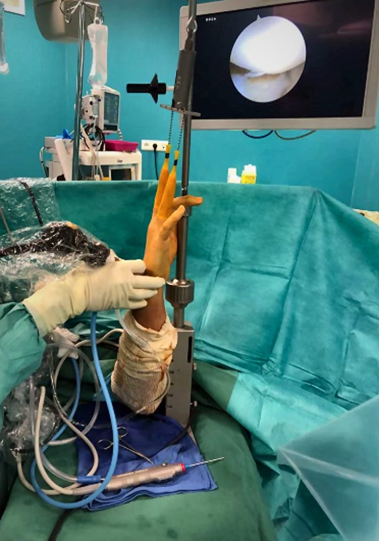Arthroscopie du poignet sur tour de traction